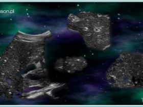 Obraz "rozgwieżdżonego nieba" wątroby - co to oznacza? - Portal wymiany wiedzy o ultrasonografii - Eduson