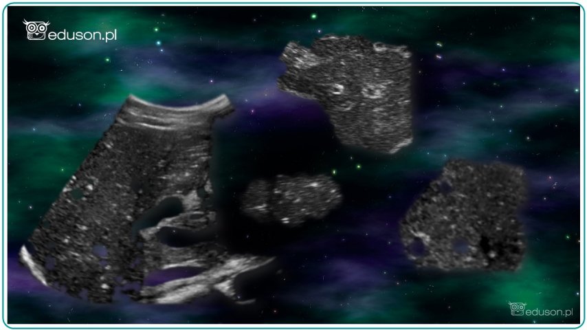 Obraz "rozgwieżdżonego nieba" wątroby - co to oznacza? | Portal wymiany wiedzy o ultrasonografii - Eduson