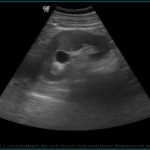 Torbiel nerki w badaniu ultrasonograficznym u osoby dorosłej - Portal wymiany wiedzy o ultrasonografii - Eduson