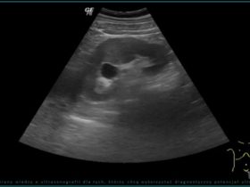 Torbiel nerki w badaniu ultrasonograficznym u osoby dorosłej | Portal wymiany wiedzy o ultrasonografii - Eduson