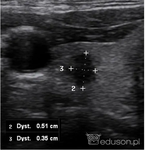 EU-TIRADS-PL | Portal wymiany wiedzy o ultrasonografii - Eduson
