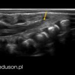 13 pytań z anatomii ultrasonograficznej OUN - sprawdź swoją wiedzę. | Portal wymiany wiedzy o ultrasonografii - Eduson