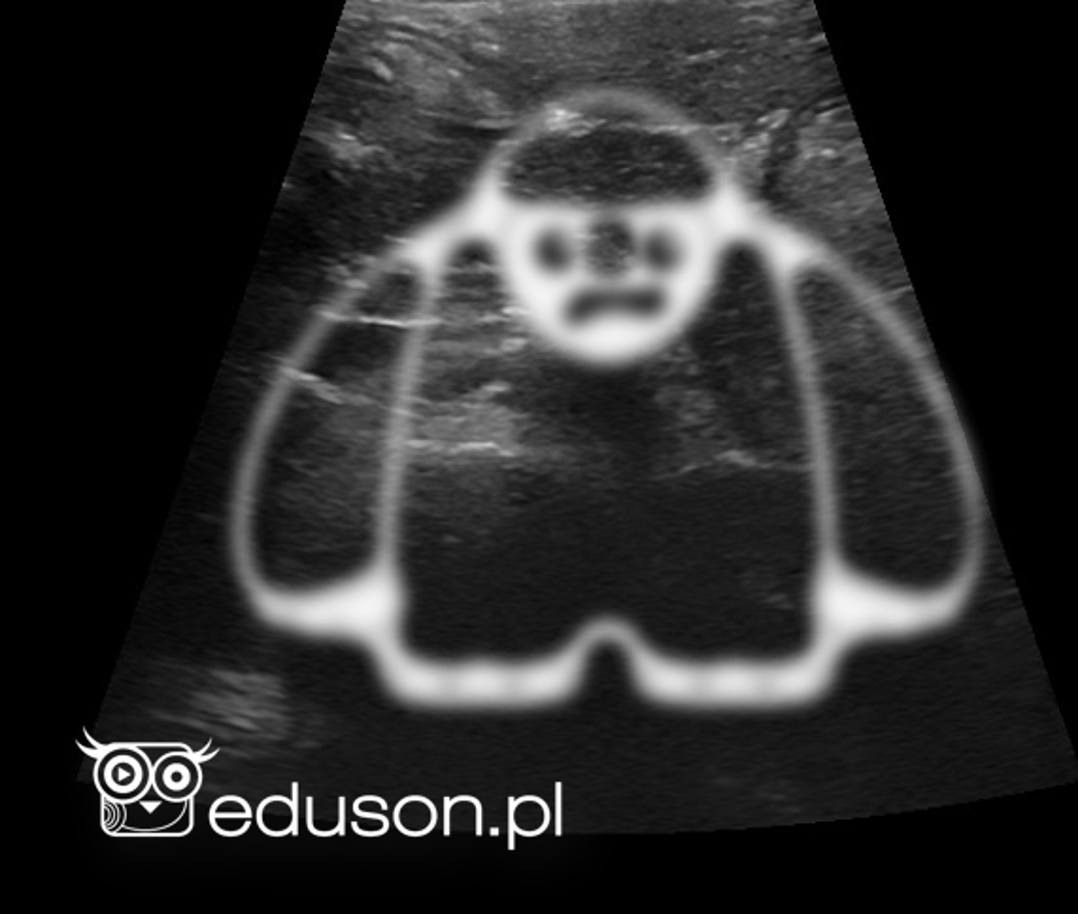 Ultrasonograficzny narząd Yeti