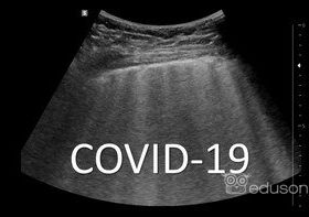 Ultrasonograficzny obraz płuc u pacjentów z COVID-19 | Portal wymiany wiedzy o ultrasonografii - Eduson
