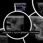Tydzień z życia liniowej głowicy Lumify | Portal wymiany wiedzy o ultrasonografii - Eduson