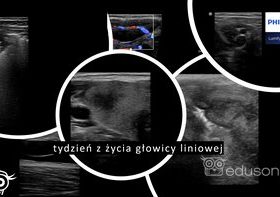 Tydzień z życia liniowej głowicy Lumify - Portal wymiany wiedzy o ultrasonografii - Eduson