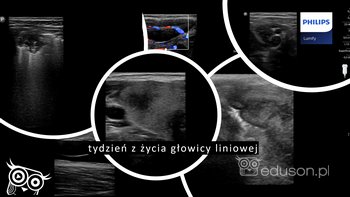 Tydzień z życia liniowej głowicy Lumify | Portal wymiany wiedzy o ultrasonografii - Eduson