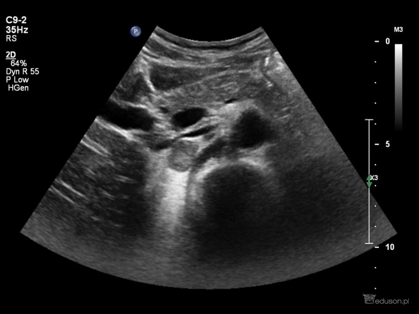 Pacjentka z nadciśnieniem tętniczym, po incydencie utraty przytomności - Portal wymiany wiedzy o ultrasonografii - Eduson