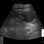 Rak nerki | Portal wymiany wiedzy o ultrasonografii - Eduson