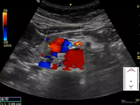 Tętniak tętnicy trzustkowo-dwunastniczej dolnej - Portal wymiany wiedzy o ultrasonografii - Eduson