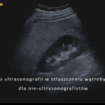 Aspekty ultrasonograficzne stłuszczenia wątroby dla nie-ultrasonografistów - w pytaniach i odpowiedziach | Portal wymiany wiedzy o ultrasonografii - Eduson