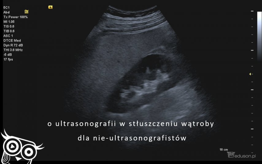 Aspekty ultrasonograficzne stłuszczenia wątroby dla nie-ultrasonografistów - w pytaniach i odpowiedziach - Portal wymiany wiedzy o ultrasonografii - Eduson