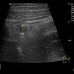 Zapalenie wyrostka robaczkowego - galeria obrazów ultrasonograficznych - część 2. | Portal wymiany wiedzy o ultrasonografii - Eduson