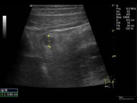 Zapalenie wyrostka robaczkowego - galeria obrazów ultrasonograficznych - część 2. - Portal wymiany wiedzy o ultrasonografii - Eduson