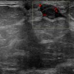 Który to BIRADS-usg? - Portal wymiany wiedzy o ultrasonografii - Eduson