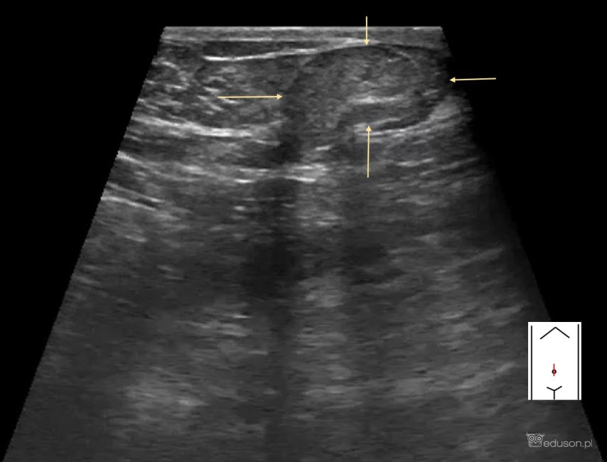 "Czy to guzek siostry Mary Joseph?" - zapytała przerażona pacjentka. | Portal wymiany wiedzy o ultrasonografii - Eduson