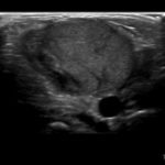 Synek ma dopiero miesiąc, a tu taki guz na szyi urósł... - Portal wymiany wiedzy o ultrasonografii - Eduson