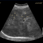 Przerzuty nowotworów złośliwych do wątroby - Portal wymiany wiedzy o ultrasonografii - Eduson