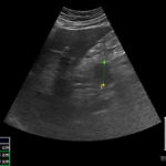 Rak trzustki | Portal wymiany wiedzy o ultrasonografii - Eduson