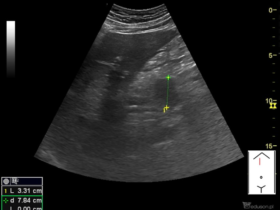 Rak trzustki - Portal wymiany wiedzy o ultrasonografii - Eduson
