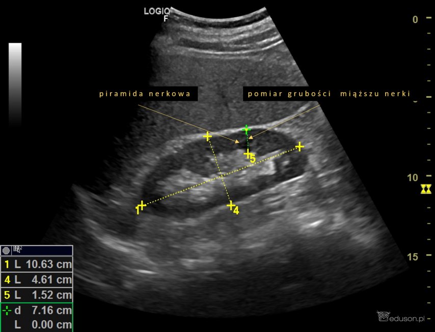 Lewa nerka przekrój podłużny - obraz ultrasonograficzny. Zaznaczony jest pomiar warstwy miąższowej nerki. Aparat GE LOGIQ F6. Głowica konweksowa 4C.