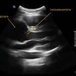 Pacjent z kaszlem i poszerzonym cieniem śródpiersia w badaniu rtg | Portal wymiany wiedzy o ultrasonografii - Eduson