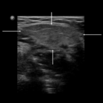 "Żabka" w badaniu usg - Portal wymiany wiedzy o ultrasonografii - Eduson