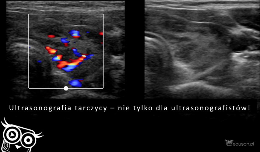 Ultrasonografia tarczycy - nie tylko dla ultrasonografistów!
