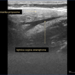 ślinianki - Portal wymiany wiedzy o ultrasonografii - Eduson