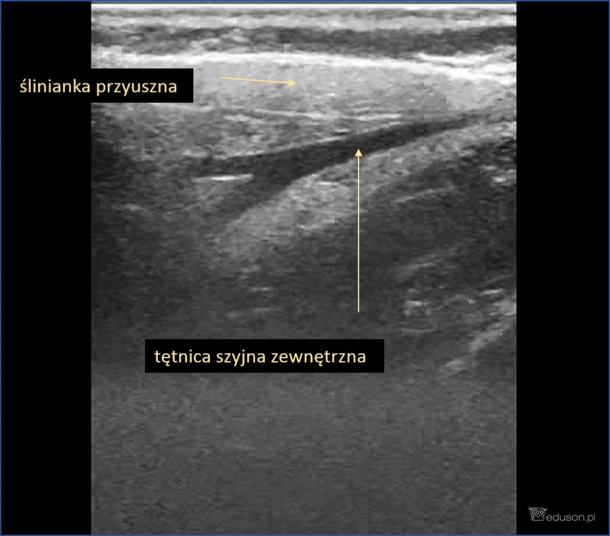 ślinianki - Portal wymiany wiedzy o ultrasonografii - Eduson