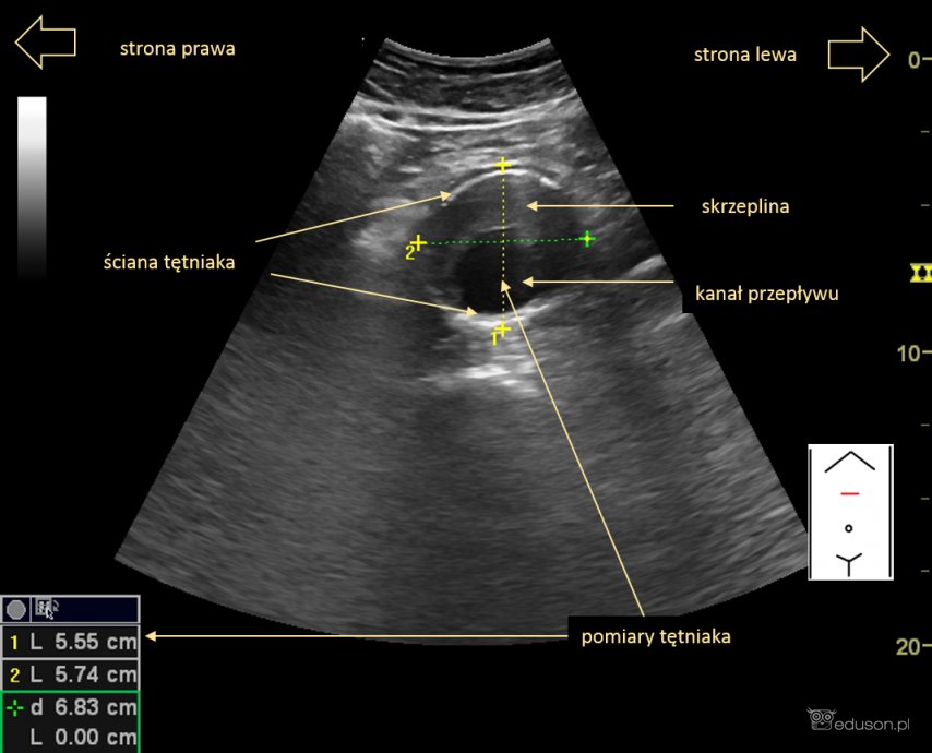 tętniak aorty brzusznej usg - przekrój poprzeczny tętniaka, płaszczyzna poprzeczna. 