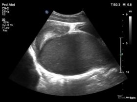 13-letnia dziewczynka z nawracającymi bólami podbrzusza | Portal wymiany wiedzy o ultrasonografii - Eduson