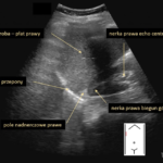 jak wygląda prawidłowy obraz USG pól nadnerczowych | Portal wymiany wiedzy o ultrasonografii - Eduson