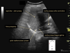 pola nadnerczowe - Portal wymiany wiedzy o ultrasonografii - Eduson