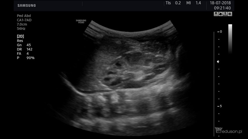 Obraz usg nerki noworodka w obrazowaniu głowicą konweksową CA1-7AD. Aparat usg Samsung HS60.