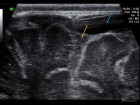 Zapalenie opon mózgowo-rdzeniowych u 3-miesięcznego dziecka. | Portal wymiany wiedzy o ultrasonografii - Eduson