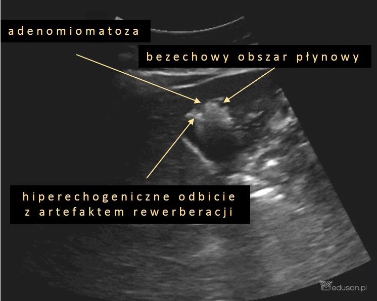 Adenomiomatoza pęcherzyka żółciowego. Obraz ultrasonograficzny