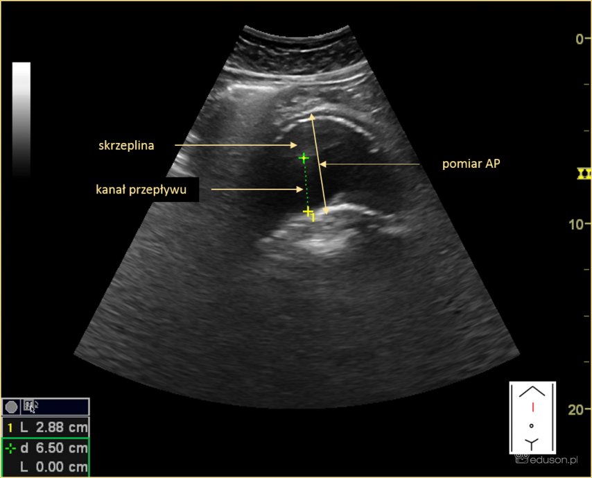 Tętniak aorty brzusznej w USG - Portal wymiany wiedzy o ultrasonografii - Eduson