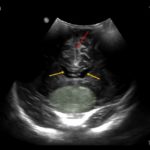 4-miesięczne dziecko z oczopląsem poziomym - Portal wymiany wiedzy o ultrasonografii - Eduson
