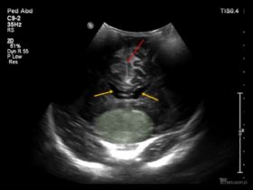 4-miesięczne dziecko z oczopląsem poziomym | Portal wymiany wiedzy o ultrasonografii - Eduson