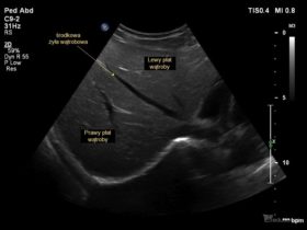 jak wygląda prawidłowy obraz USG wątroby | Portal wymiany wiedzy o ultrasonografii - Eduson