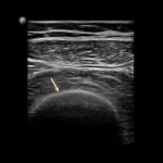 Rola USG we wstępnej diagnostyce złamań kości długich - Portal wymiany wiedzy o ultrasonografii - Eduson