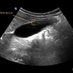 artefakty ultrasonograficzne | Portal wymiany wiedzy o ultrasonografii - Eduson