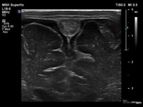2-miesięczne dziecko po incydencie drgawek | Portal wymiany wiedzy o ultrasonografii - Eduson
