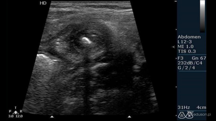Zapalenie wyrostka robaczkowego - galeria obrazów ultrasonograficznych