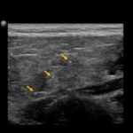 Zespół Sjogrena – obraz ultrasonograficzny ślinianek | Portal wymiany wiedzy o ultrasonografii - Eduson