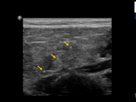 Zespół Sjogrena – obraz ultrasonograficzny ślinianek | Portal wymiany wiedzy o ultrasonografii - Eduson