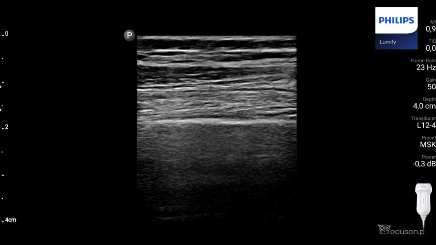 Fragment kości udowej w przekroju podłużnym u dorosłego mężczyzny. Głowica liniowa. Philips Lumify. Obraz ultrasonograficzny.