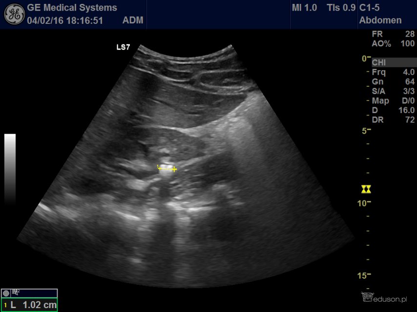 Od wczoraj mnie tak strasznie boli w pachwinie... | Portal wymiany wiedzy o ultrasonografii - Eduson