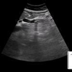 "Panie doktorze, brzuch mnie boli... tak jak przed operacją pęcherzyka żółciowego" | Portal wymiany wiedzy o ultrasonografii - Eduson